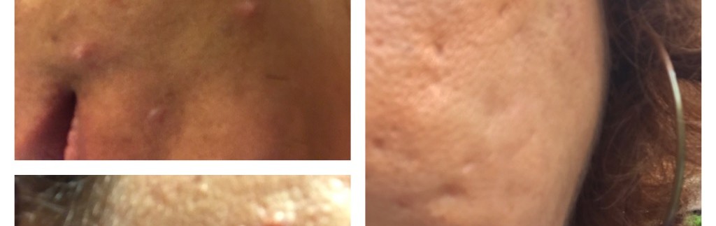 Help with Cystic Acne